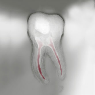 Die Wurzelspitzenresektion (WSR) bietet eine Möglichkeit Zahnsubstanz zu retten